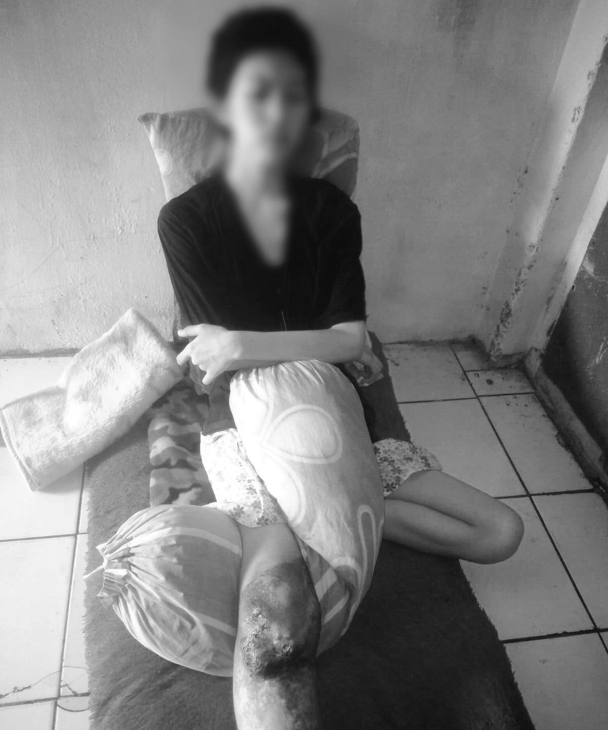 Chyntiya Amelia Maharani, gadis pengidap kanker tulang terpaksa harus menunda sekolah karena penyakit